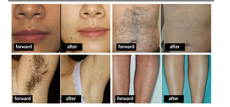 Diode Laser Hair Removal Machine Permanently Hair Removal Laser Beauty Device Portable 755nm 808nm 1064nm Hair Removal Machine