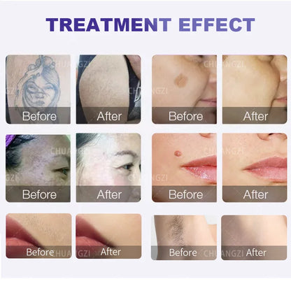 Hot Sale: 2-in-1 Ice Diode Laser Hair Removal Machine, 755, 808, 1064 nm Q-Switched Nd:YAG Picosecond Tattoo Price Beauty Equipm